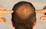 This one thing causes hair fall fast due to overeating, be careful in food and drink