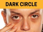 dark circles